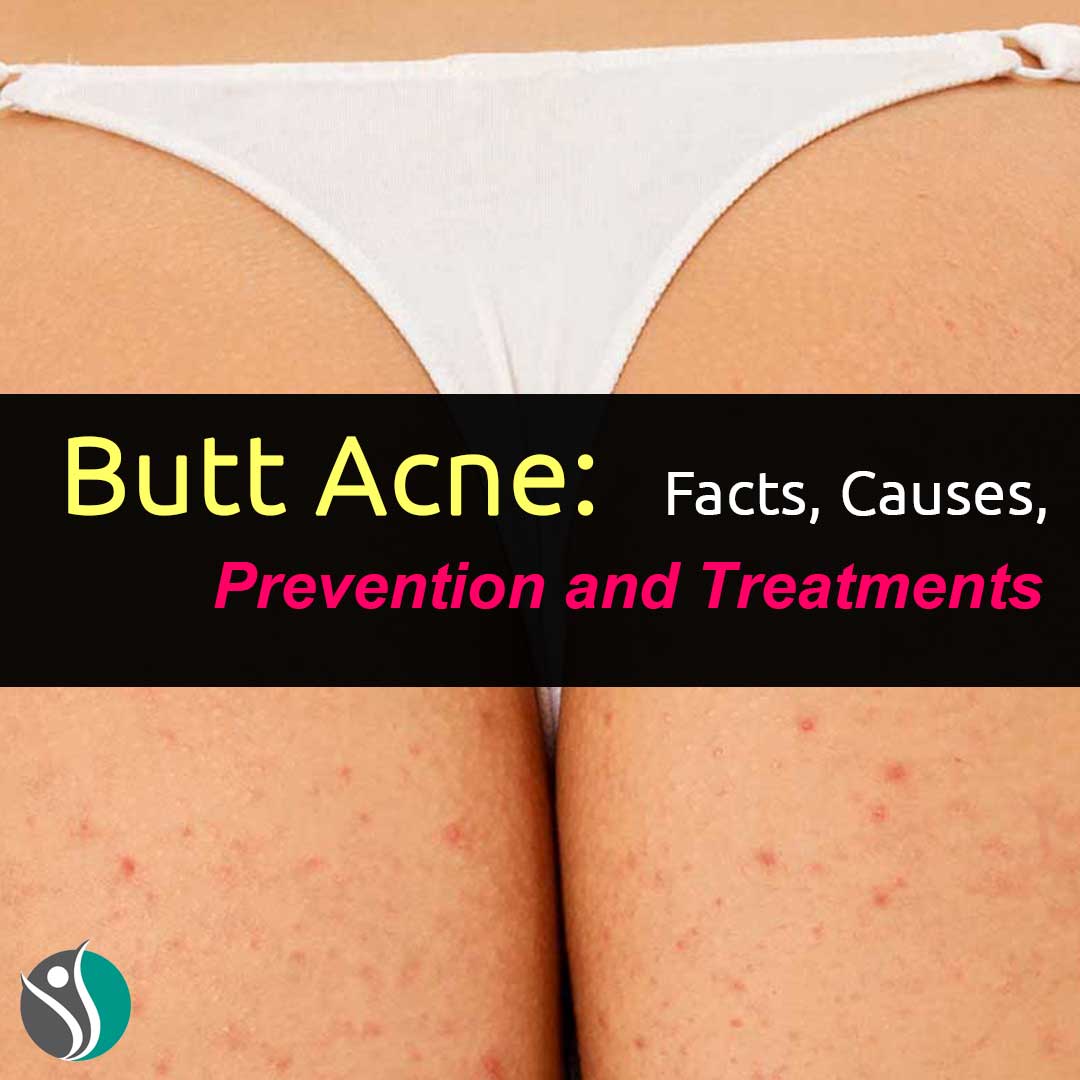 How to Get Rid of Butt Acne: Home Remedies, Medical Treatments